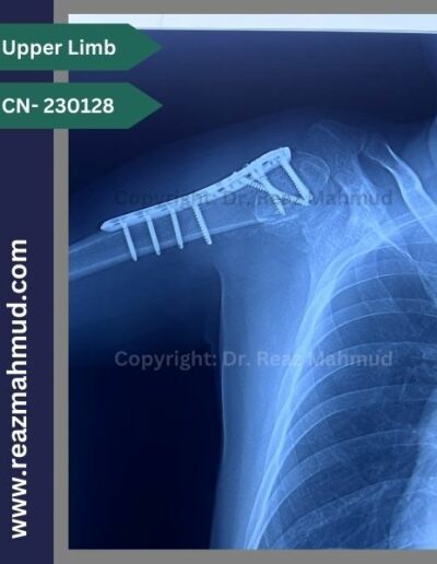 Fracture Dislocation of humerus head Follow up