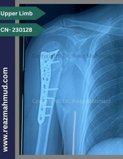 Fracture Dislocation of humerus head Follow up