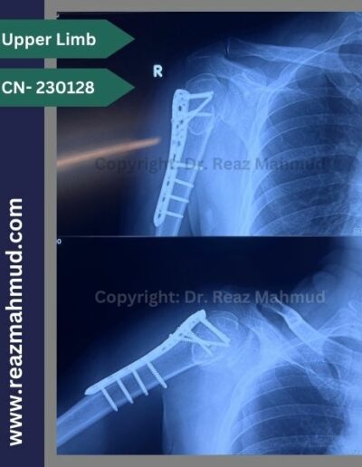 Fracture Dislocation of humerus head Follow up