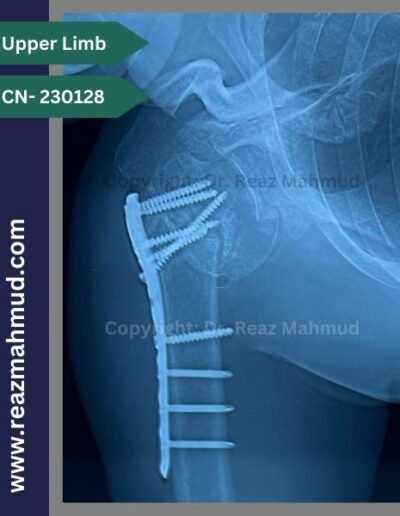 Fracture Dislocation of humerus head Follow up