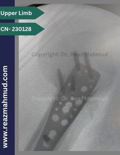 Fracture Dislocation of humerus head Peroperative