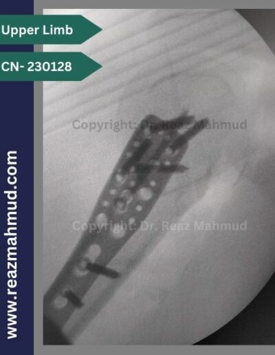 Fracture Dislocation of humerus head Peroperative