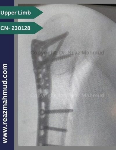 Fracture Dislocation of humerus head Peroperative