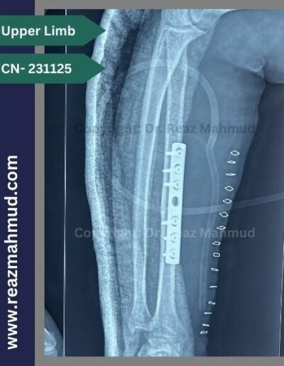 Fracture Radius postoperative