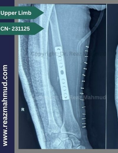 Fracture Radius postoperative