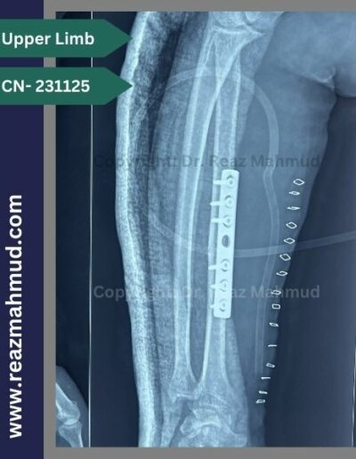 Fracture Radius postoperative