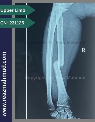 Fracture Radius preoperative