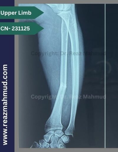 Fracture Radius preoperative