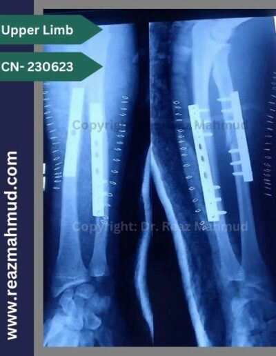 Fracture Shaft or Radius Ulna Postoperative