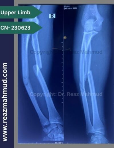 Fracture Shaft or Radius Ulna Preoperative