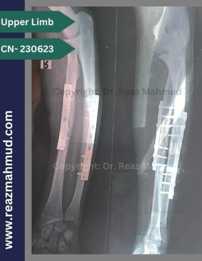 Fracture Shaft or Radius Ulna follow up