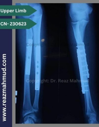 Fracture Shaft or Radius Ulna follow up