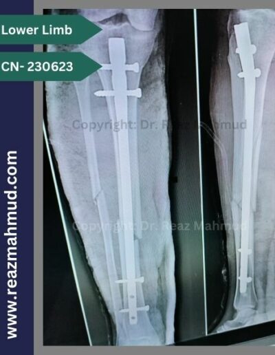 Fracture Tibia-Fibula Postoperative