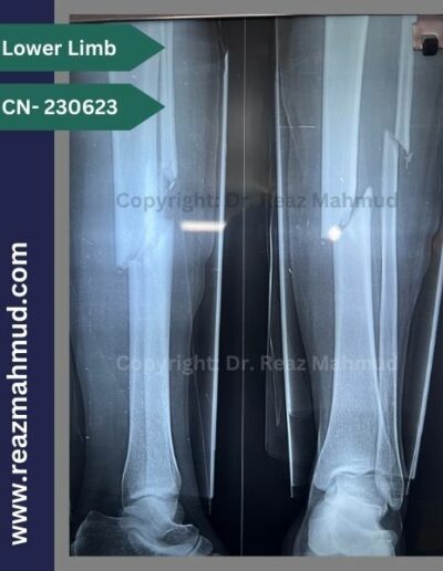 Fracture Tibia-Fibula Preoperative