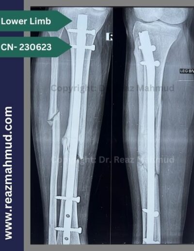 Fracture Tibia-Fibula follow up