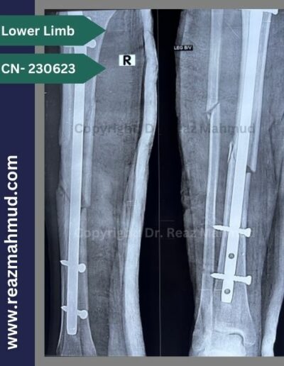 Fracture Tibia-Fibula follow up