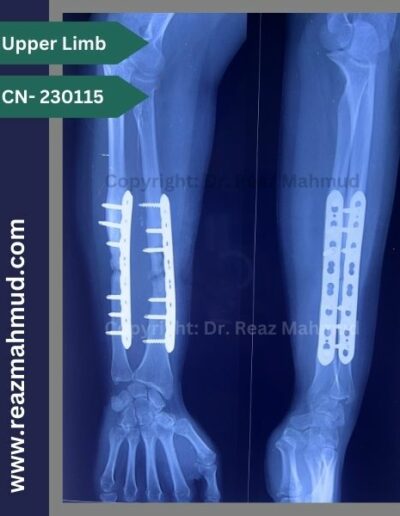 Infected nonunion follow up