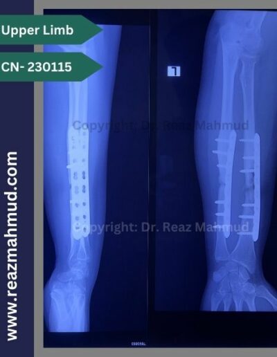 Infected nonunion follow up