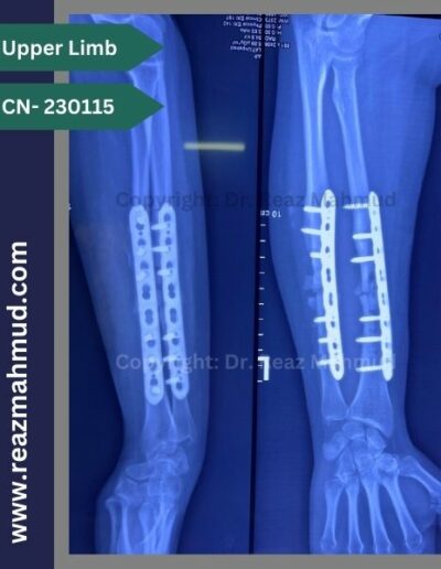 Infected nonunion follow up