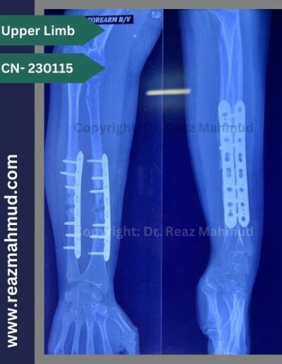 Infected nonunion follow up