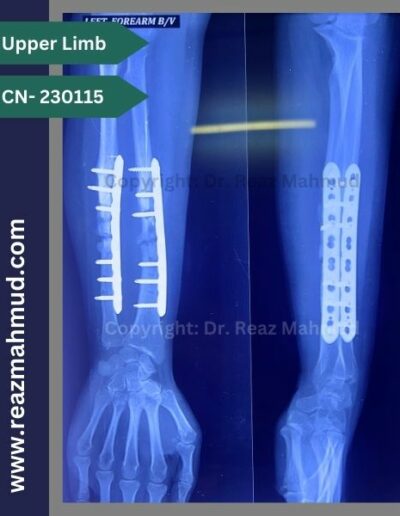 Infected nonunion follow up