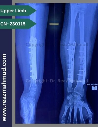 Infected nonunion follow up