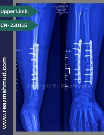 Infected nonunion follow up