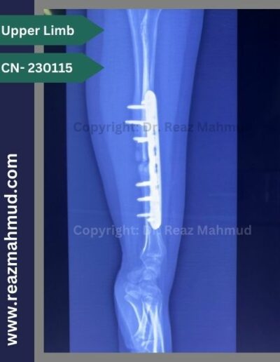 Infected nonunion follow up