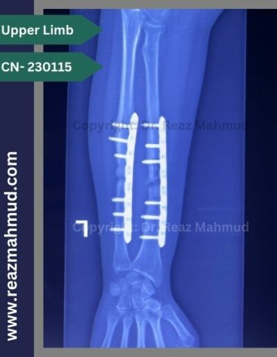 Infected nonunion follow up