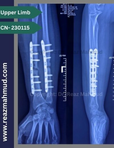 Infected nonunion follow up