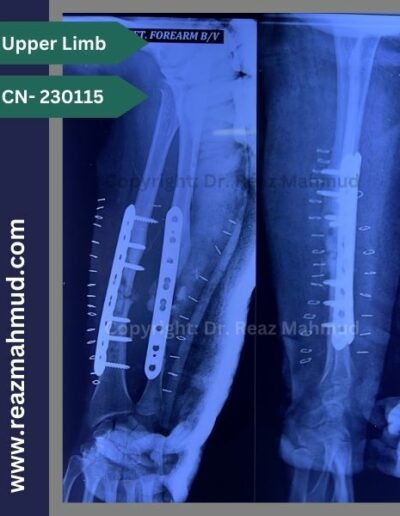 Infected nonunion postoperative