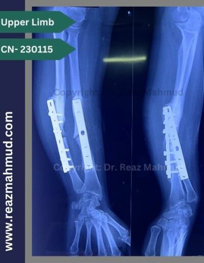 Infected nonunion preoperative