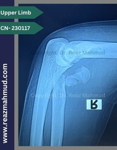 Radial Head Fracture preoperative