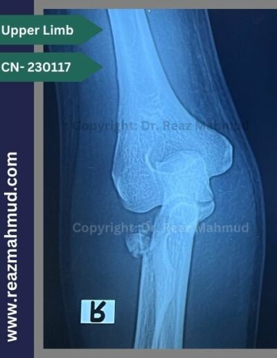 Radial Head Fracture preoperative