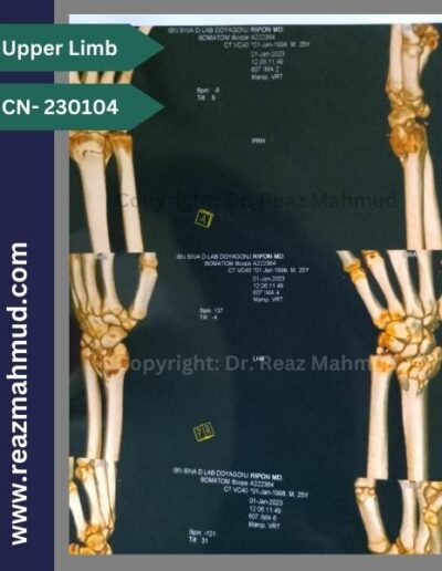 Volar Barton Fracture 3D CT