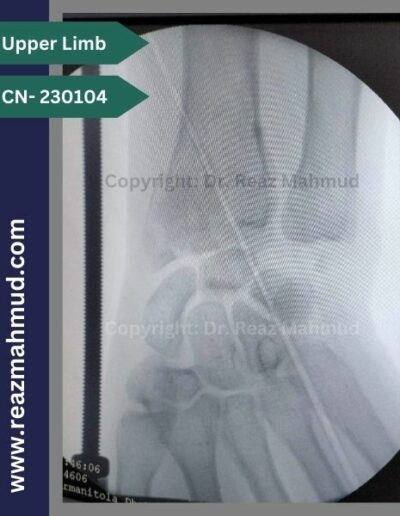 Volar Barton Fracture Peroperative (2)