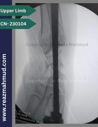 Volar Barton Fracture Peroperative (3)