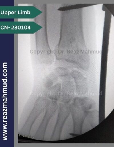 Volar Barton Fracture Peroperative (2)