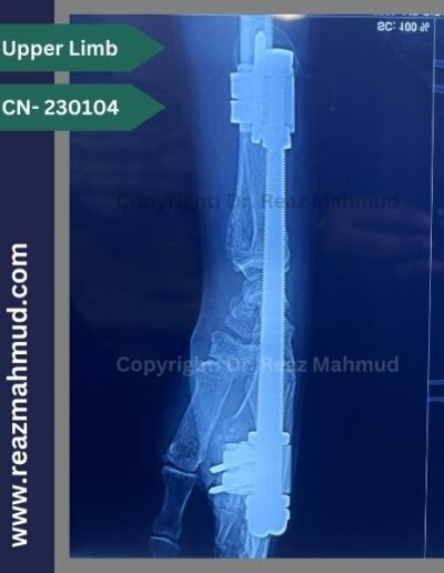 Volar Barton Fracture Postoperative