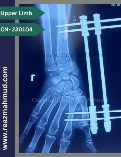 Volar Barton Fracture Postoperative