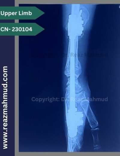 Volar Barton Fracture Postoperative