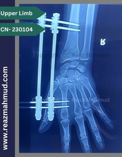 Volar Barton Fracture Postoperative