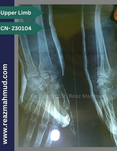 Volar Barton Fracture Preoperative (2)