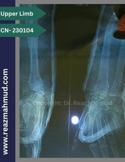 Volar Barton Fracture Preoperative (2)