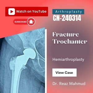 Hemiarthroplasty | Trochanter Fracture [CN-240314]