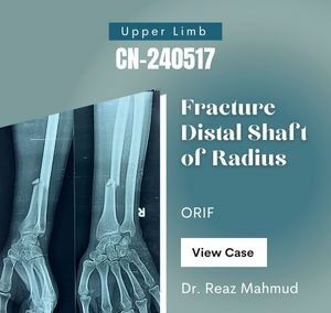 Shaft of Radius Fracture | ORIF c DCP