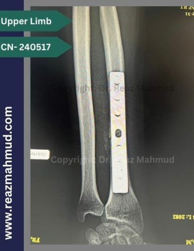 Radius fracture Postoperative