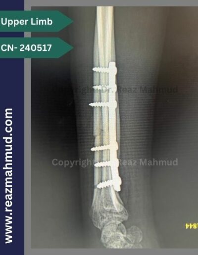 Radius fracture Postoperative (2)