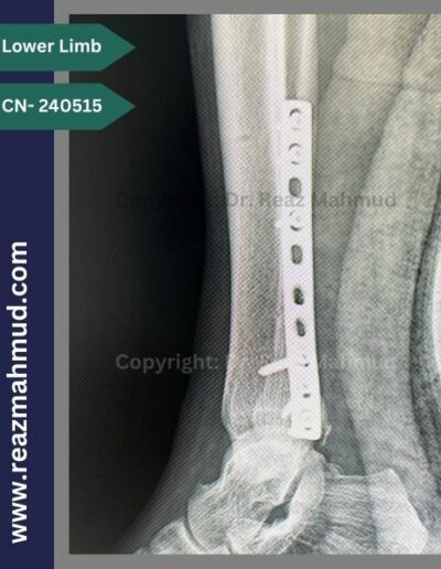 Lateral Malleolus Postoperative (2)