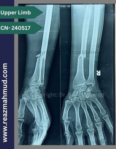 Radius fracture Preoperative